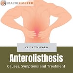 Anterolisthesis Causes treatment