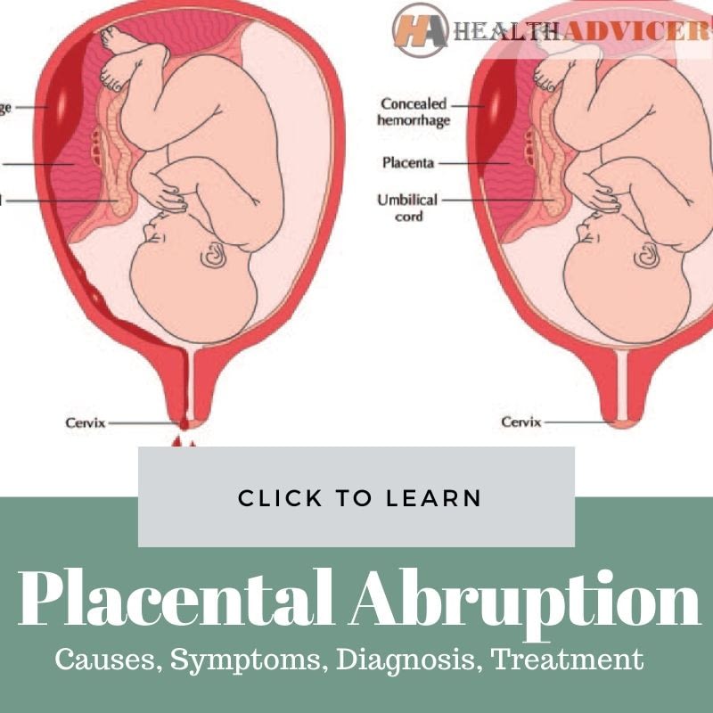 Placental Abruption Causes Picture Symptoms Risk And Treatment