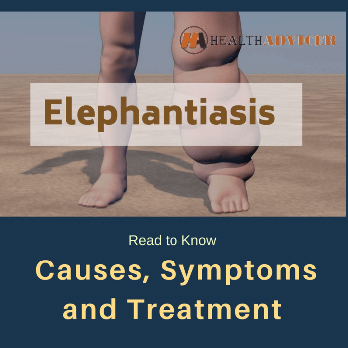 Elephantiasis